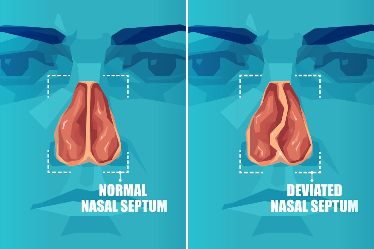 A graphic showing a normal nasal septum vs a deviated septum to explain the relation of deviated septums and sleep apnea.