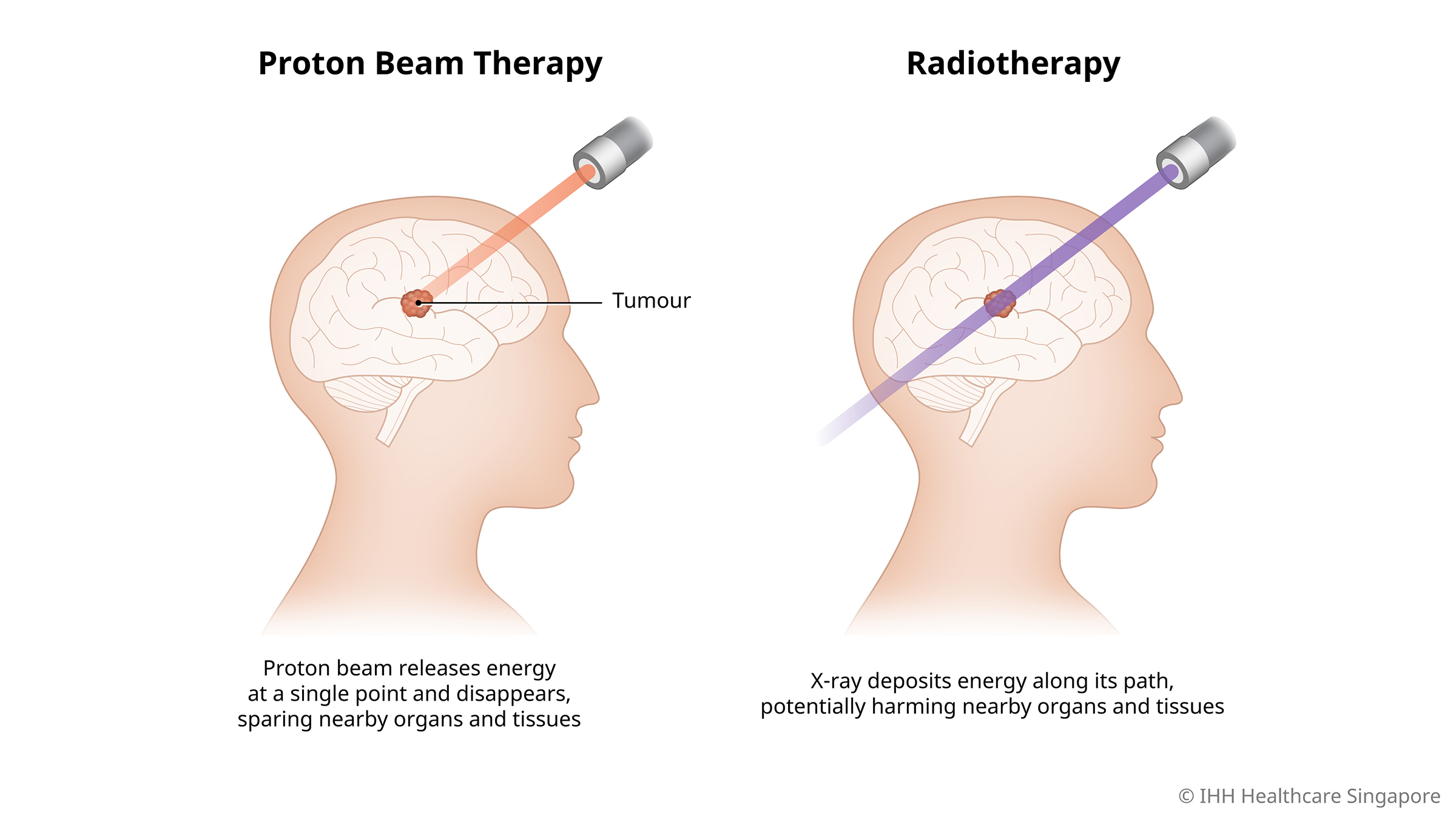 case study for proton beam therapy